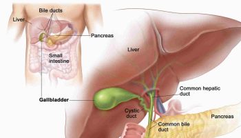 Porcelain-gallbladder