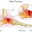 Talus-fracture