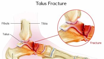 Talus-fracture