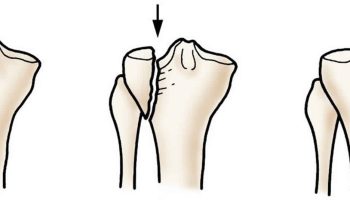 Tibial-plateau-fracture