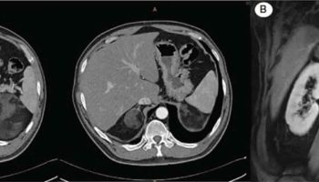 adrenal-myelolipoma