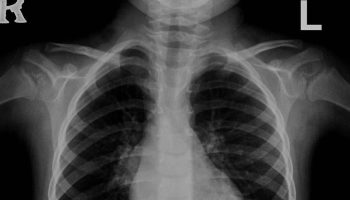 bronchogenic-cyst