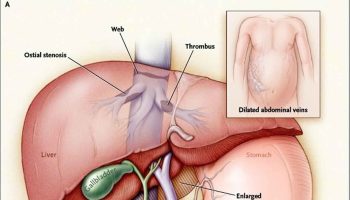 Budd Chiari syndrome