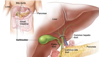 gallbladder-adenomyomatosis