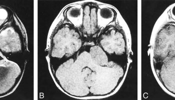 ganglioglioma