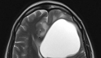 glioblastoma-multiforme