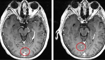 leptomeningeal-carcinomatosis