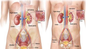 obstructive-uropathy