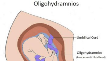 oligohydramnios