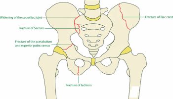 Pelvic fracture