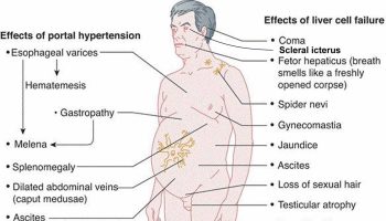 portal hypertension symptoms