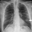 solitary-pulmonary-nodule