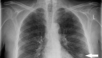 solitary-pulmonary-nodule