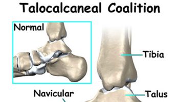 tarsal-coalition