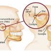 temporomandibular joint disorders