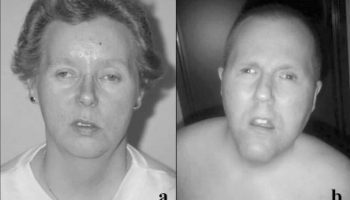 Bardet-Biedl syndrome facial features