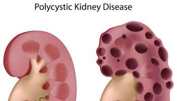 Polycystic kidney disease