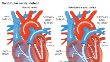 Ventricular-septal-defect