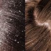 dandruff