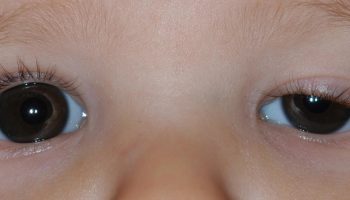 Congenital ptosis