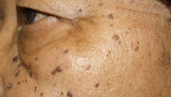 Dermatosis-papulosa-nigra