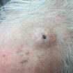 Dilated-pore-of-Winer