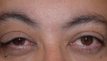 Floppy eyelid syndrome