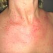 Still’s disease