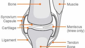 Synovial-chondromatosis