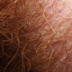 Trichomycosis-axillaris