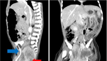 Yolk sac carcinoma