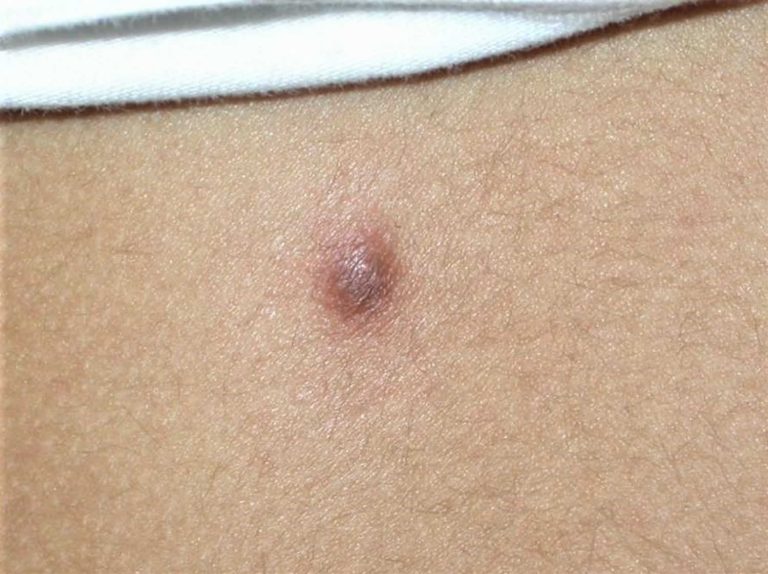 Pilomatricoma, pilomatrixoma, causes, signs, symptoms, diagnosis ...