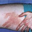delayed-pressure-urticaria