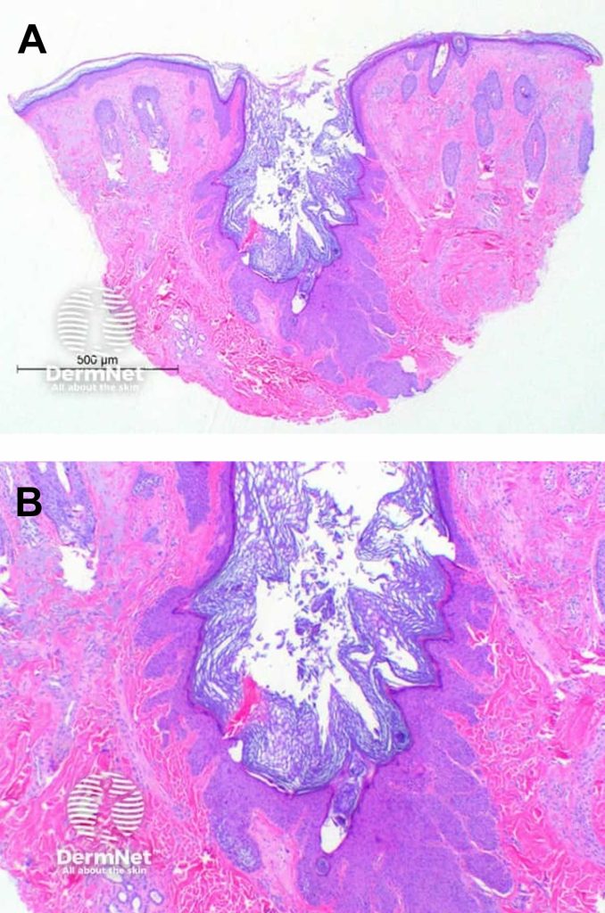 Dilated pore of Winer definition, causes, symptoms, diagnosis & treatment