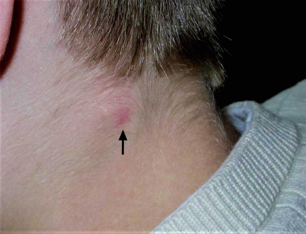 Pilomatricoma, pilomatrixoma, causes, signs, symptoms, diagnosis ...