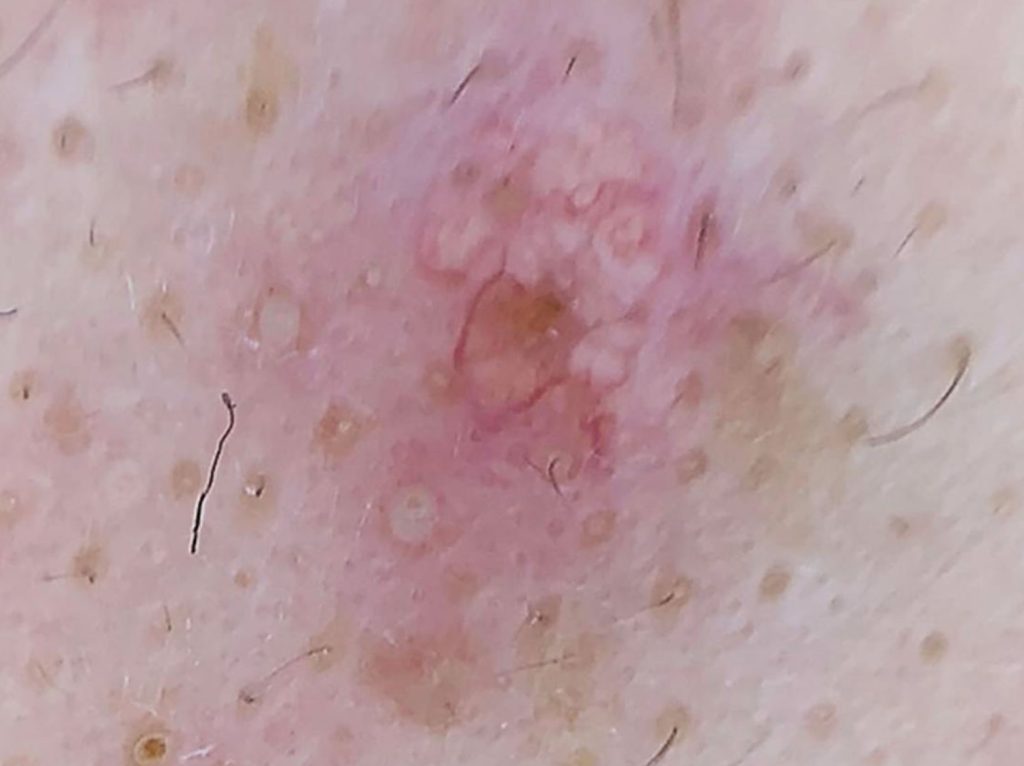 Sebaceous hyperplasia causes, signs, symptoms, diagnosis & treatment