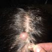 trichilemmal-cyst