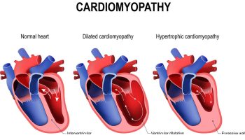 Danon-disease