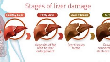 Hepatic-encephalopathy