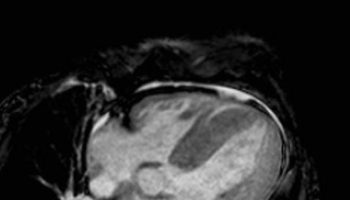 Restrictive cardiomyopathy