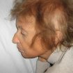 Werner-syndrome