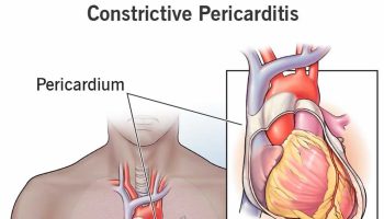 constrictive pericarditis