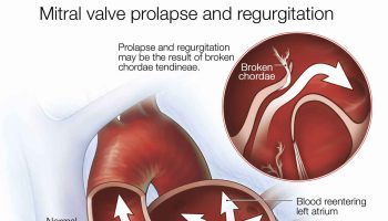 mitral-valve-regurgitation