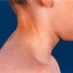 pseudoxanthoma-elasticum