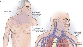 superior vena cava syndrome