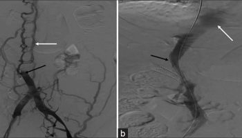 Inferior vena cava syndrome