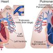 Pulmonary arterial hypertension