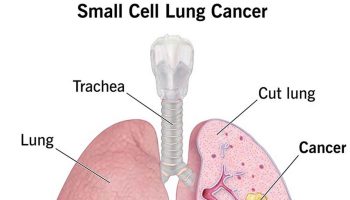 Small Cell Lung Cancer