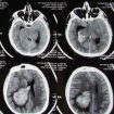 Turcot syndrome