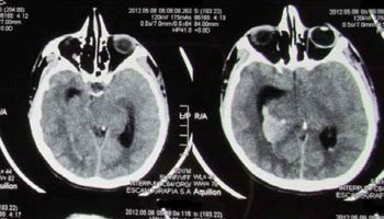 Turcot syndrome